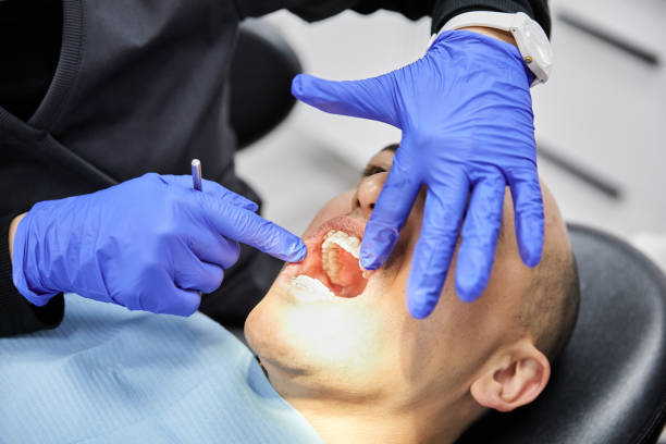 Best Knocked-Out Tooth (Avulsed Tooth) Treatment in Milton, LA